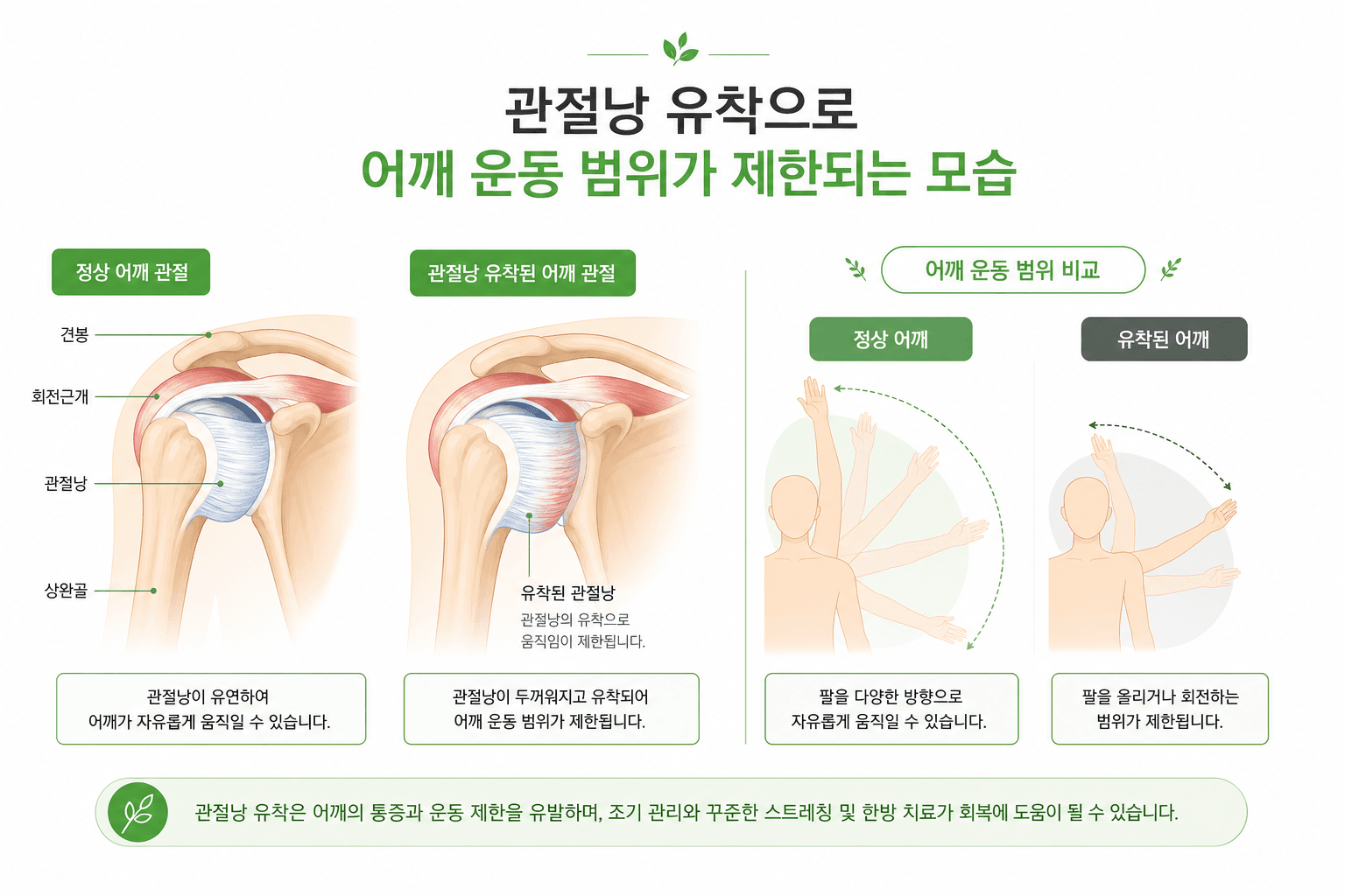 어깨가 안 올라가면 다 오십견일까? 오십견 회전근개 감별 포인트